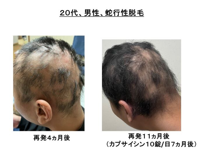 円形脱毛症　病院
